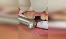 假牙制作方法视频,从视频学习精湛工艺